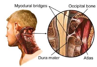 Muscle Dura Bridge